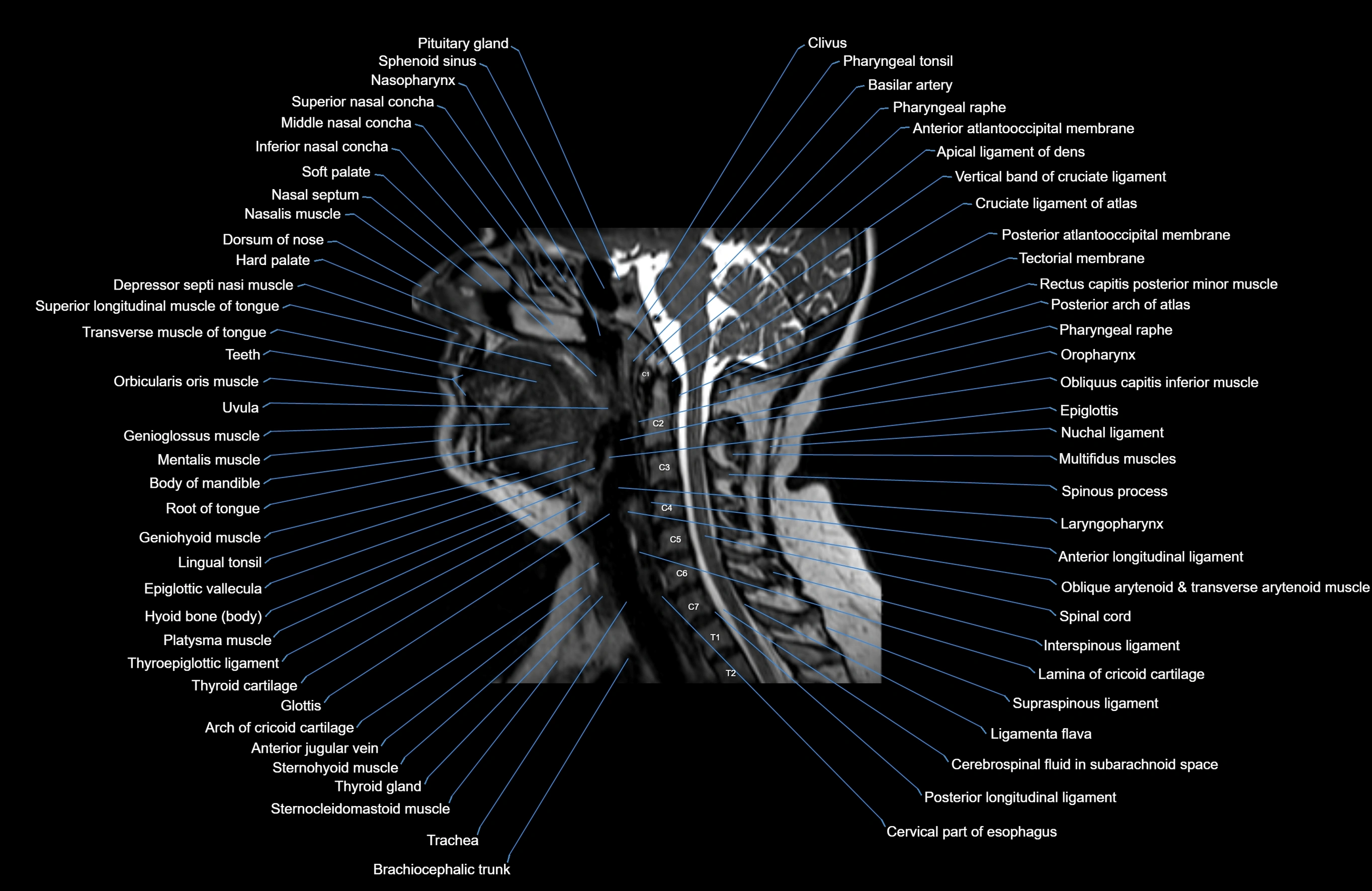 Neck MRI sagittal cross sectional anatomy 3D 1mm 3T radiology  image-img-00001-00005.webp